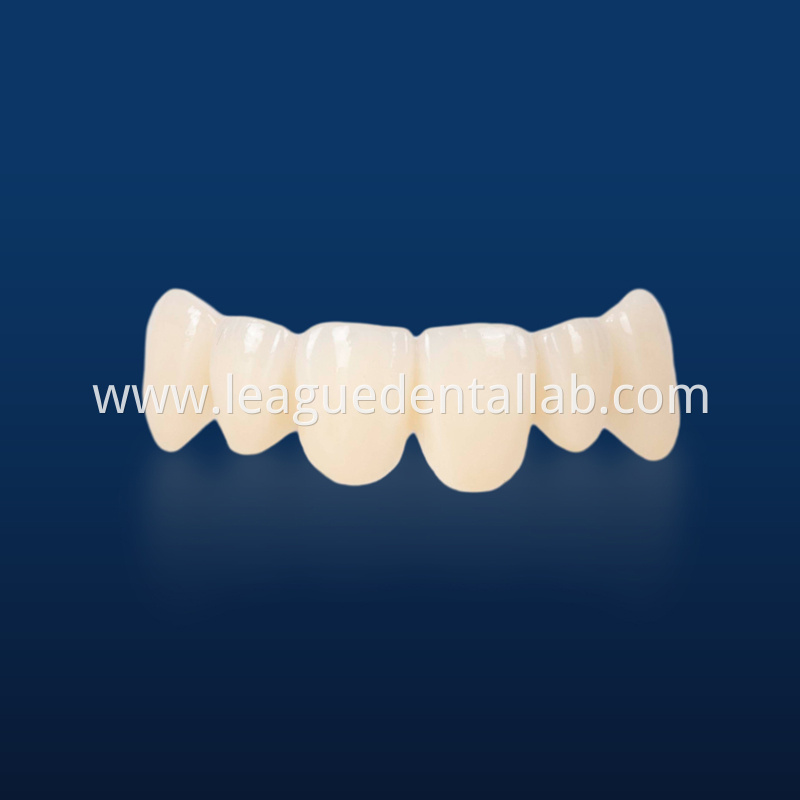 PFZ,Porcelain Fused to Zirconia,Zirconia Layered, Zirconia Veneered